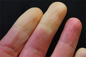 Ease Raynauds Disease